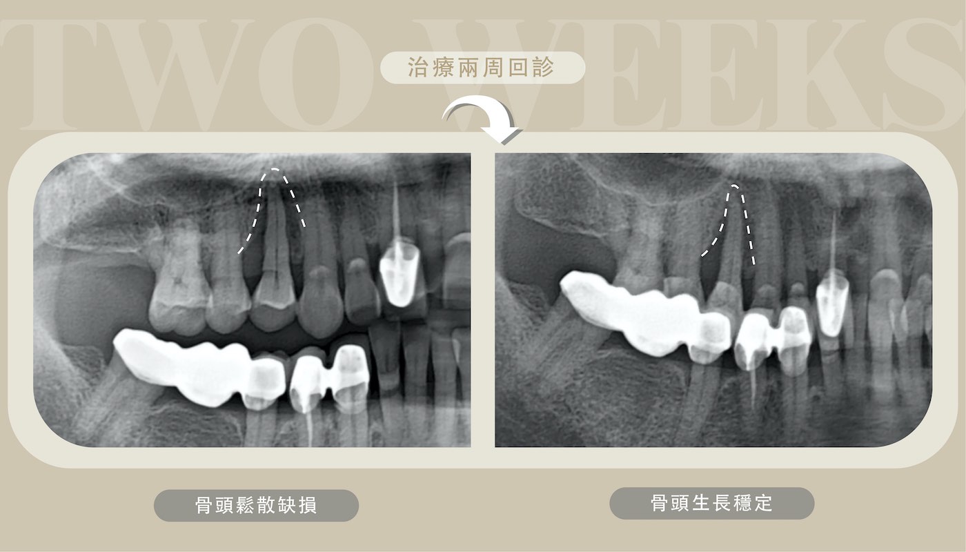 全口重建治療：治療前X光片顯示骨頭鬆散缺損；磨牙治療兩週後，X光片顯示骨頭生長穩定