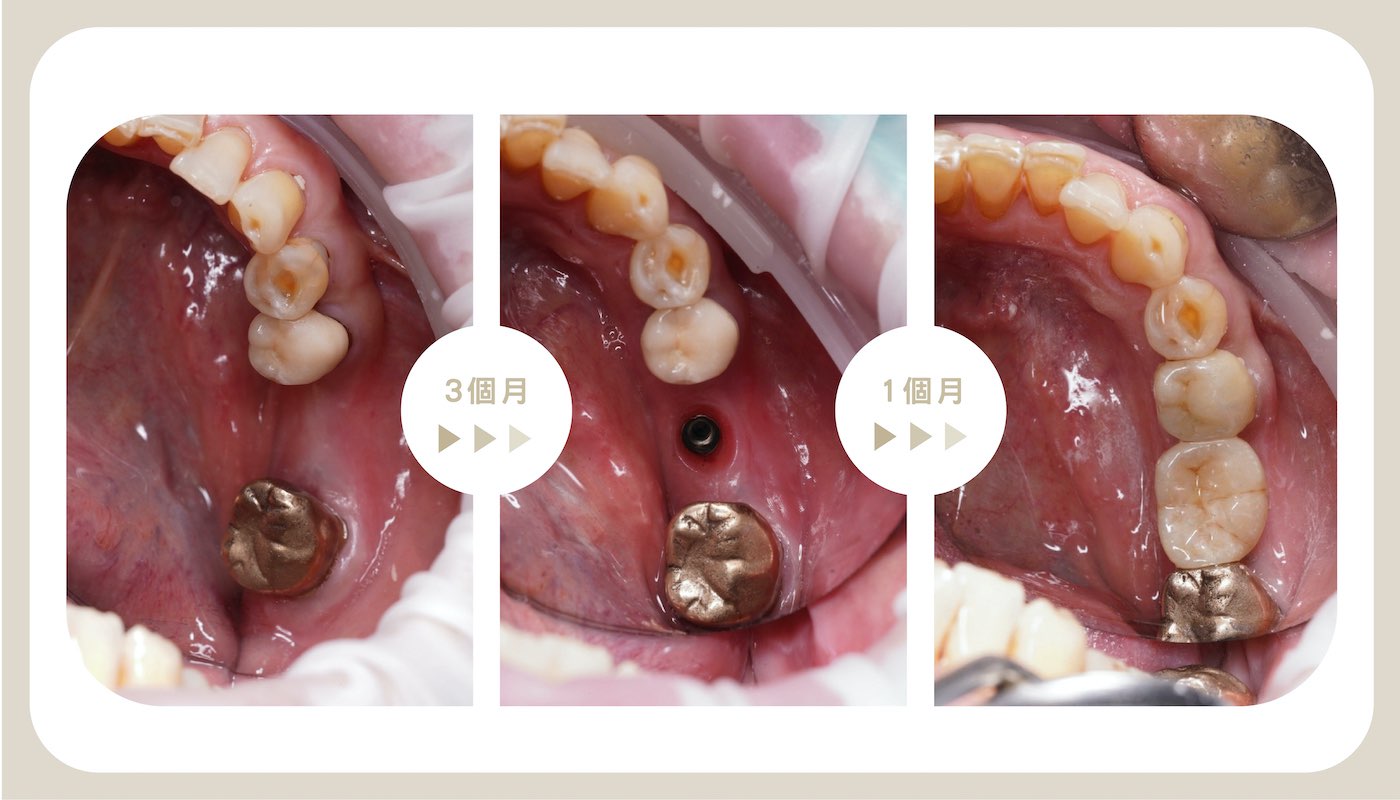 左下缺牙採微創植牙治療，約4個月後重建牙齒改善咀嚼能力