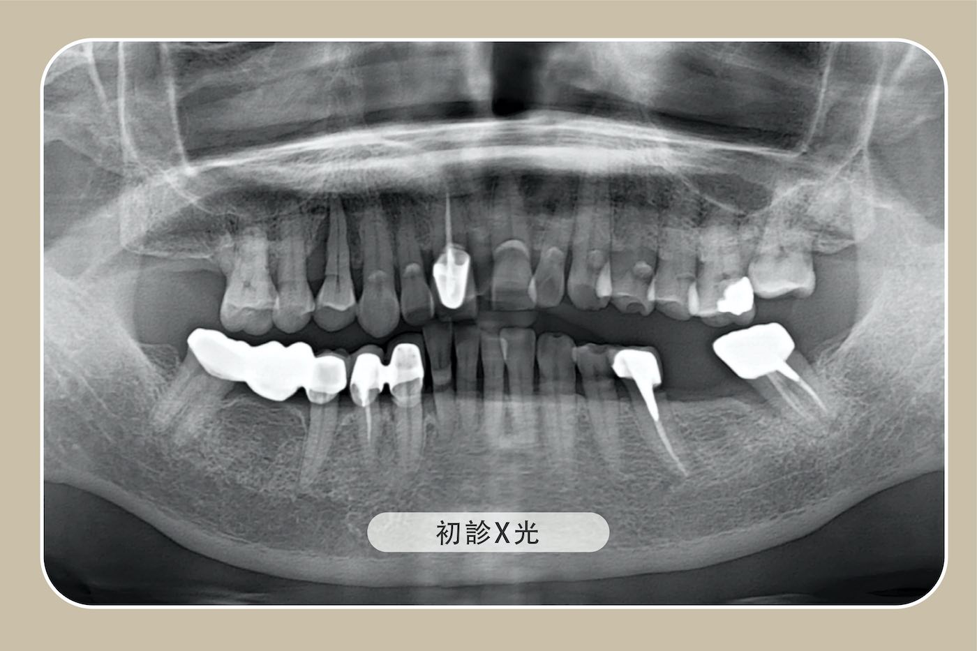 全口重建初診X光片