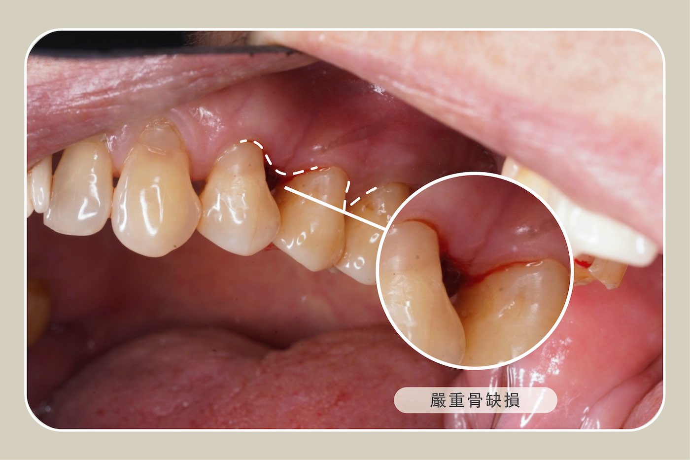 全口重建診斷：右上第二小臼齒有嚴重骨缺損及牙周疾病