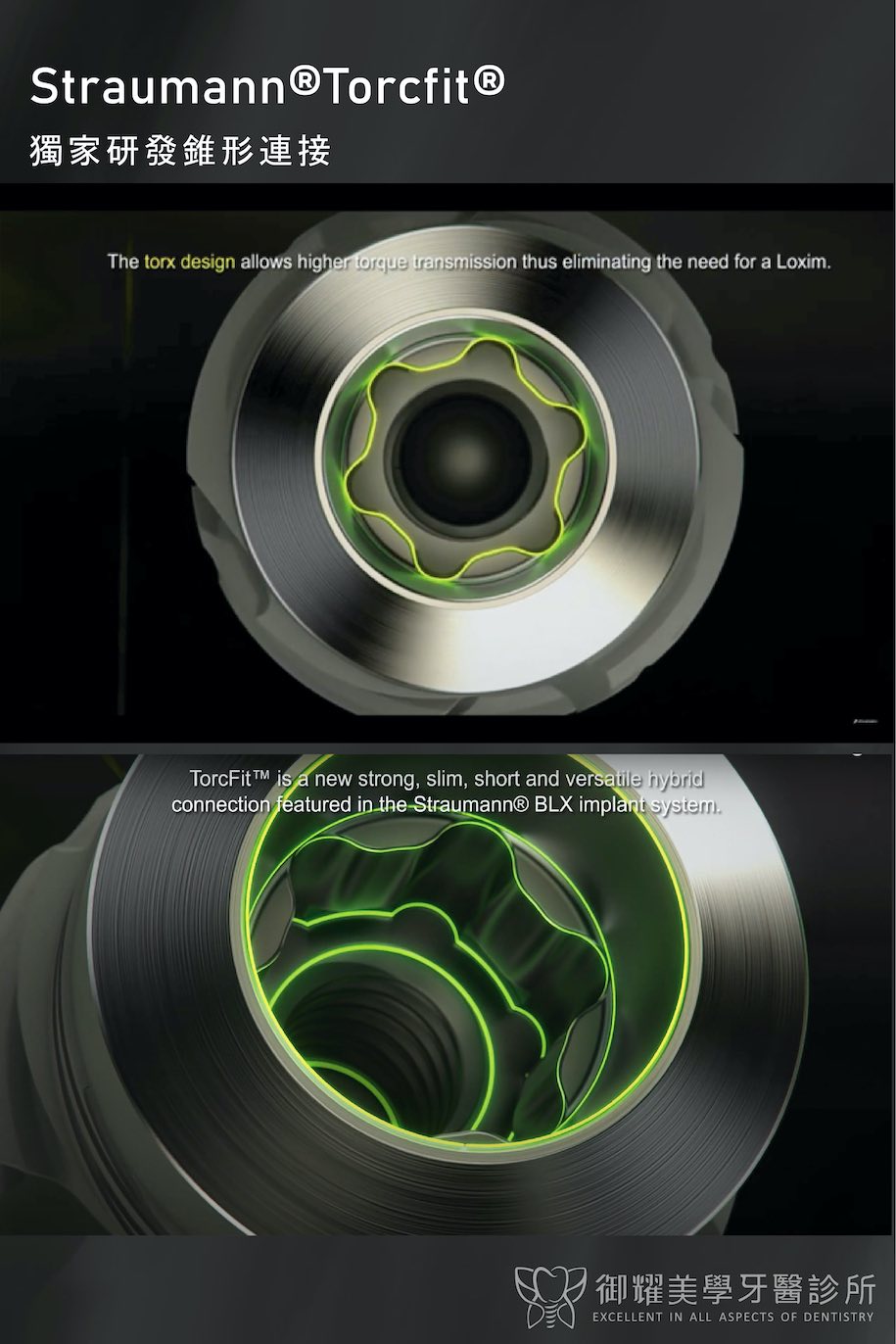 Straumann BLX植體設計：Torcfit ® 錐形連接專利