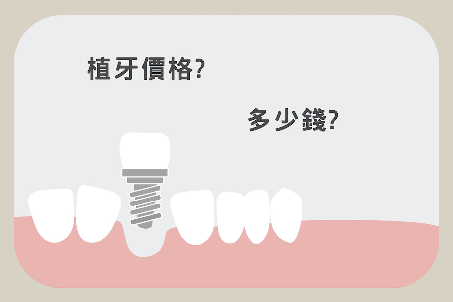 植牙價格示意圖