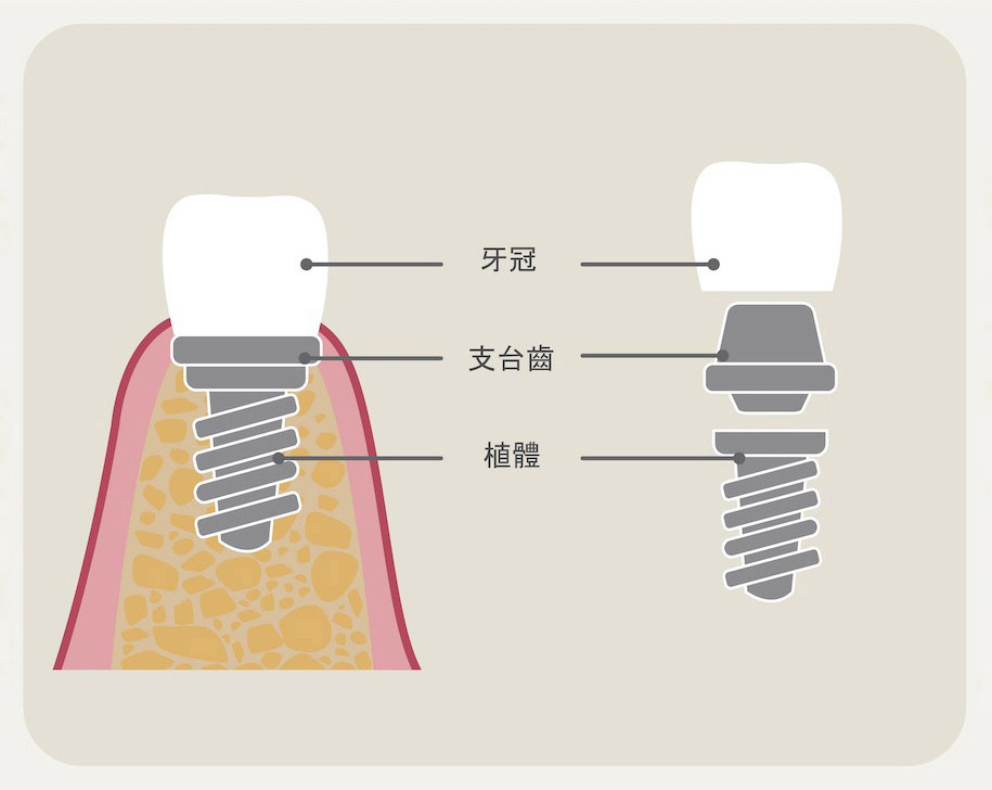 植牙組成示意圖，包含了植體、支台齒、牙冠三部分