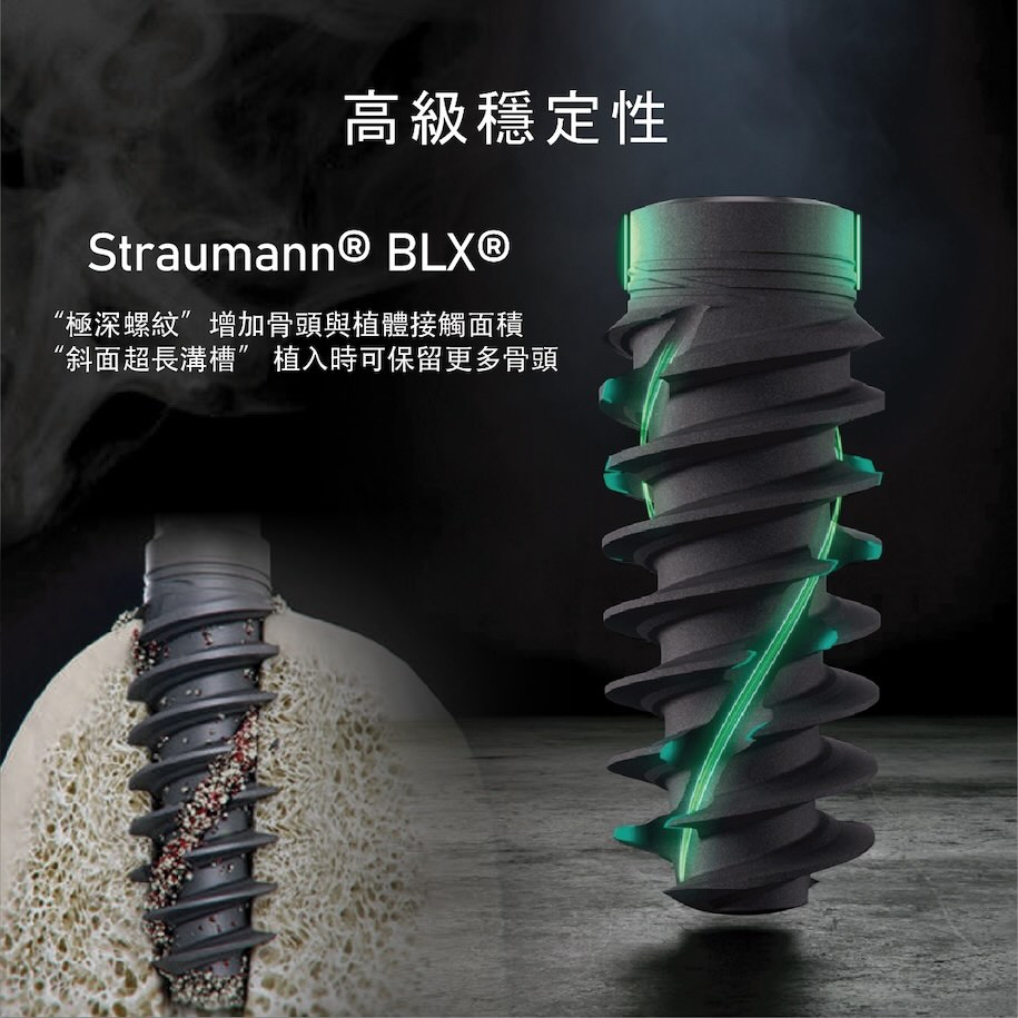 Straumann BLX植體系統的螺紋設計有增加骨頭與植體接觸面積、植入時保留更多骨頭等優點