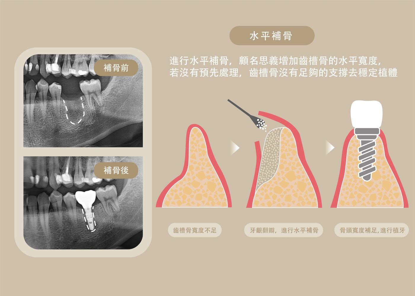 齒槽骨寬度不足，透過牙齦翻瓣進行水平補骨，骨頭寬度補足後再進行植牙