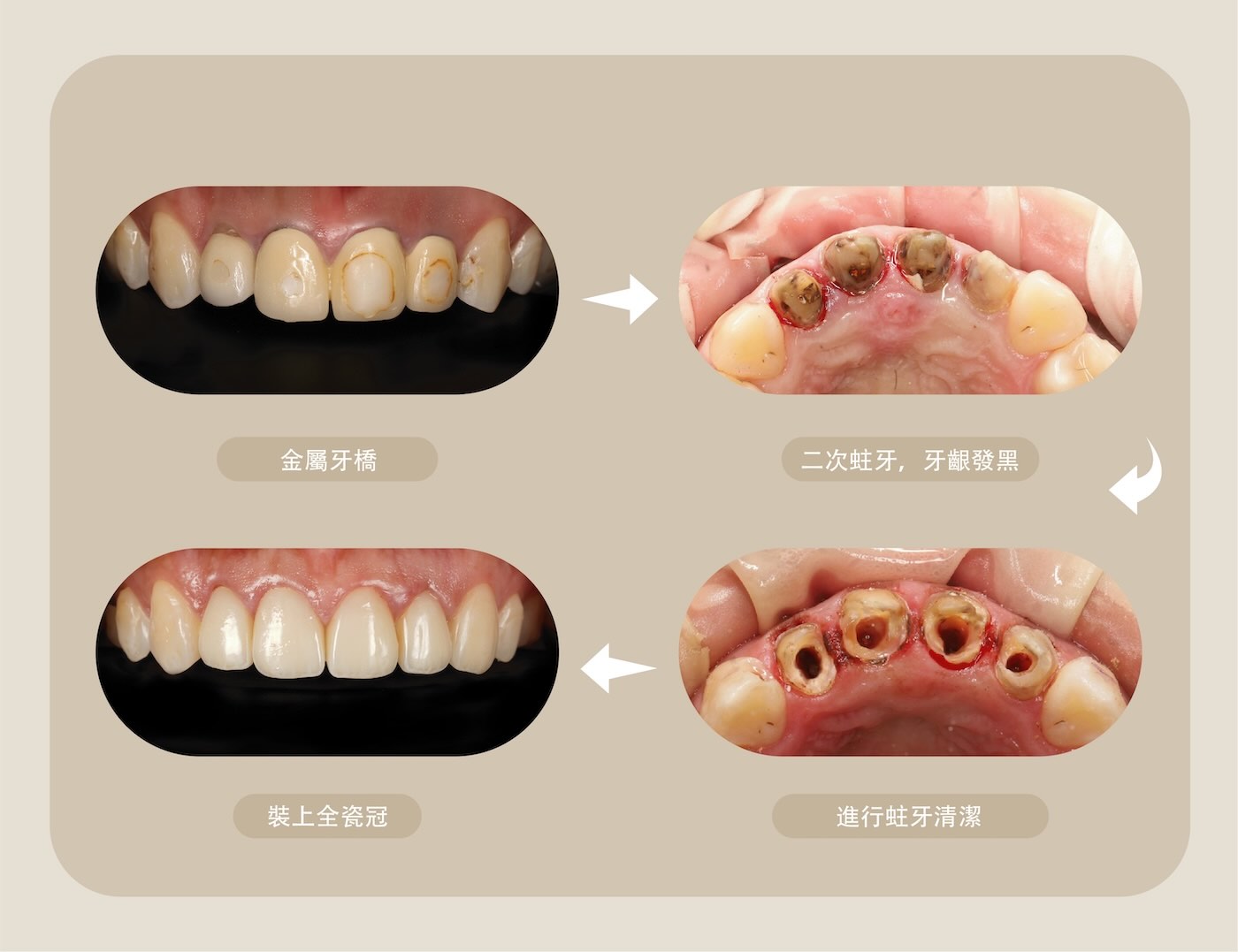 拆除金屬假牙，進行二次蛀牙治療、裝上全瓷冠的治療過程
