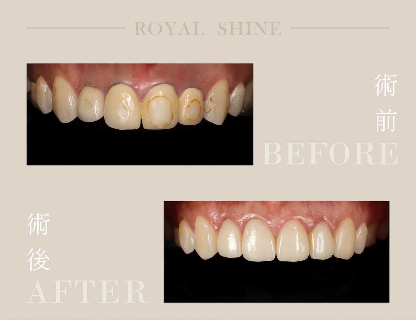 拆除牙齦變黑、不密合的金屬瓷牙，採全瓷冠修復的上排前牙外觀比較