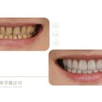 牙齒黃-門牙斷裂-門牙缺角-牙齦黑-陶瓷貼片-推薦-台中豐原-御耀美學牙醫