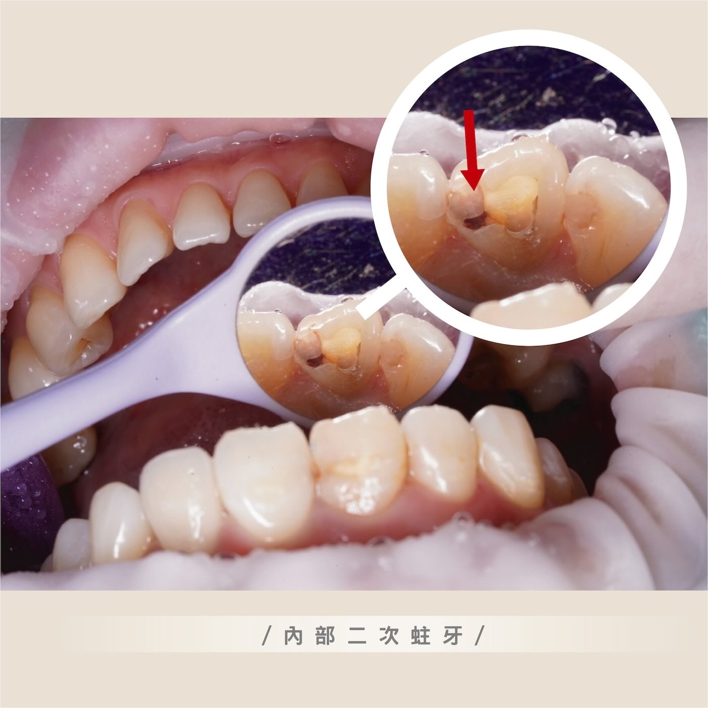 檢查發現牙齒內部仍有二次蛀牙痕跡