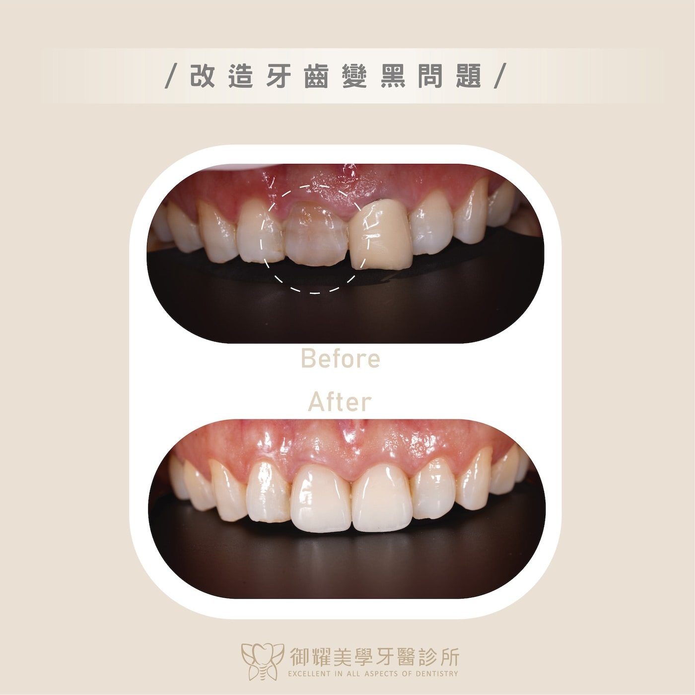 台中御耀全瓷冠案例一:根管治療後門牙變黑,修復前後比對,改善牙色與整體齒列協調度
