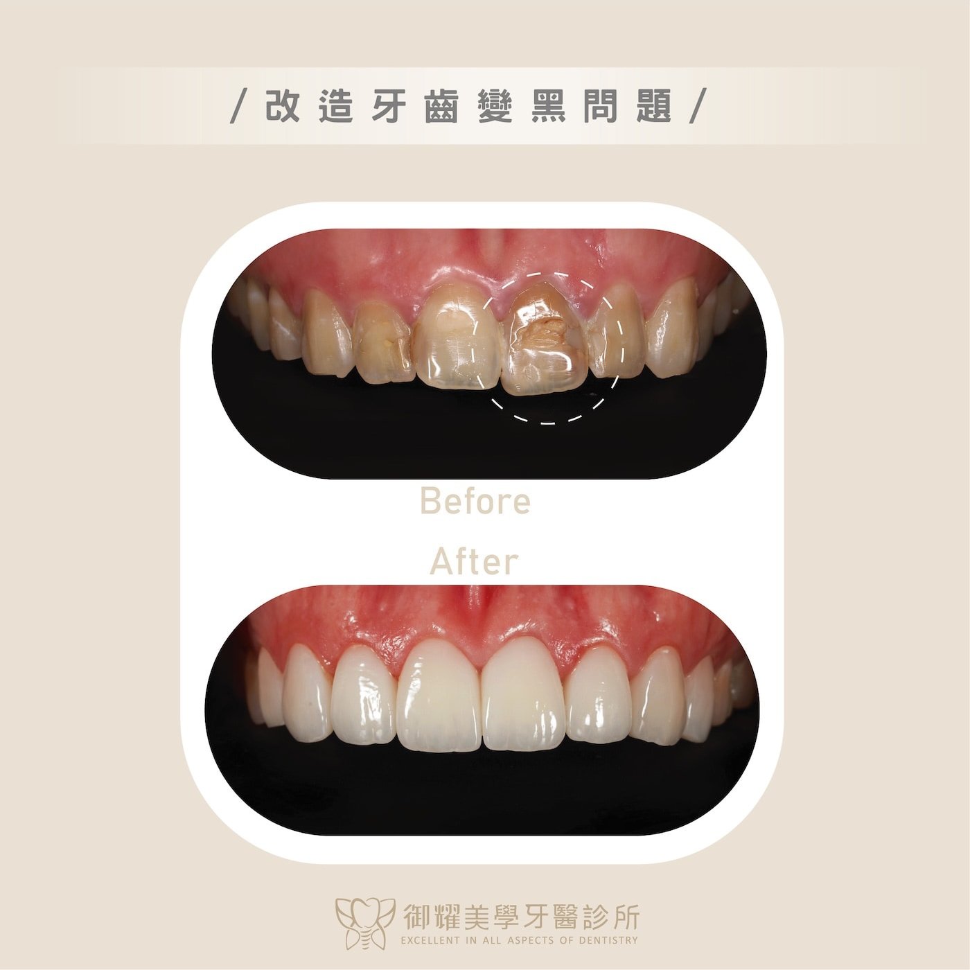 台中御耀全瓷冠案例五:多顆牙齒變黑,且門牙歪斜、微笑曲線破碎,全瓷冠修復後展現整齊潔白的新笑容