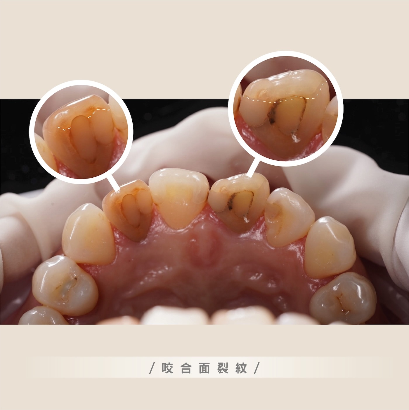 咬合面裂紋