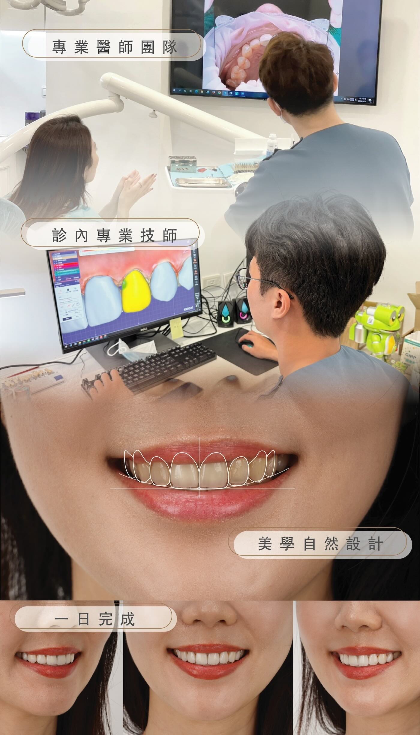 藝人Peggy接受陶瓷貼片與全瓷冠療程過程,包含醫師評估、牙技師數位設計、美學微笑設計與成果展示,強調專業團隊與一日完成效率