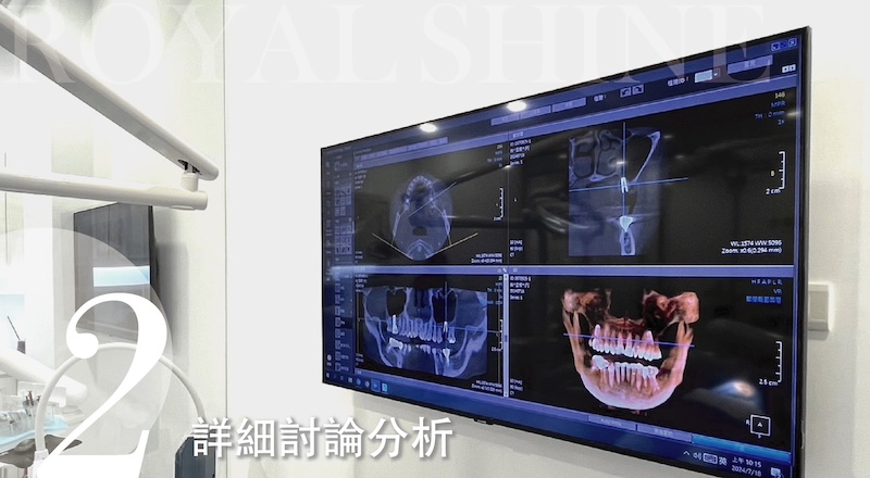 植牙療程步驟2：詳細討論分析
