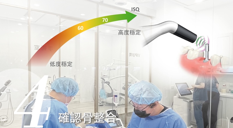 植牙療程步驟4：確認骨整合