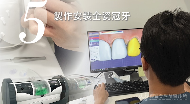 植牙療程步驟5：製作安裝全瓷冠假牙