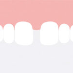 牙縫大-門牙有縫-原因-補救-關牙縫-台中牙醫推薦-御耀美學牙醫