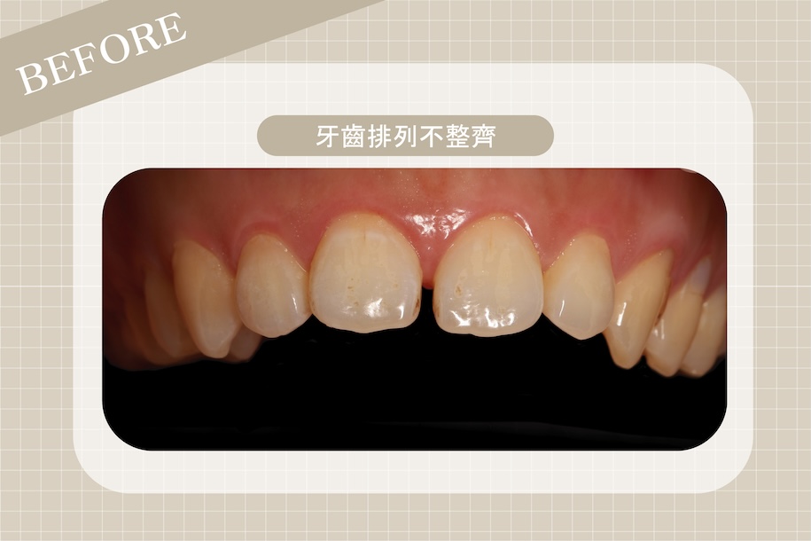 牙縫大原因1:牙齒排列不整齊導致牙縫明顯、齒列稀疏