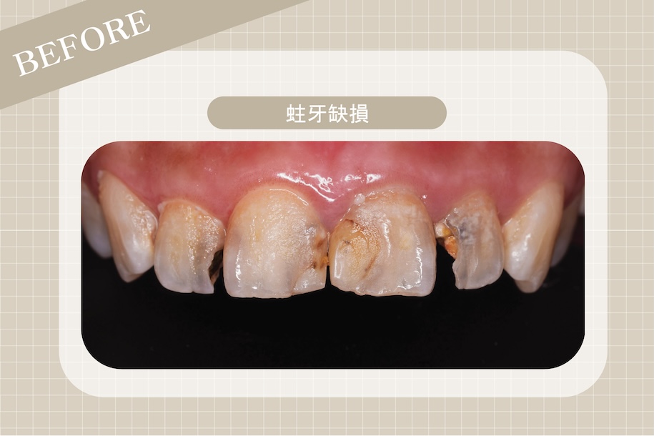 牙縫大原因4:蛀牙缺損侵蝕牙體組織,造成牙齒表面缺口與縫隙