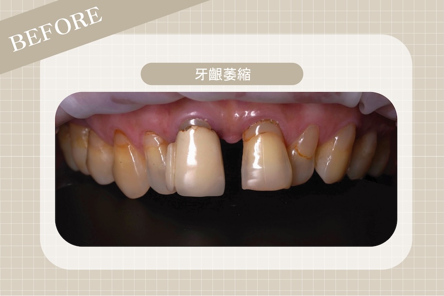 牙縫大原因3:牙齦萎縮導致牙根裸露,牙縫看起來變大