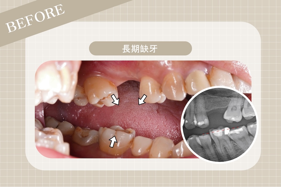 牙縫大原因2:長期缺牙未處理導致鄰牙傾斜移位,產生牙縫與清潔死角