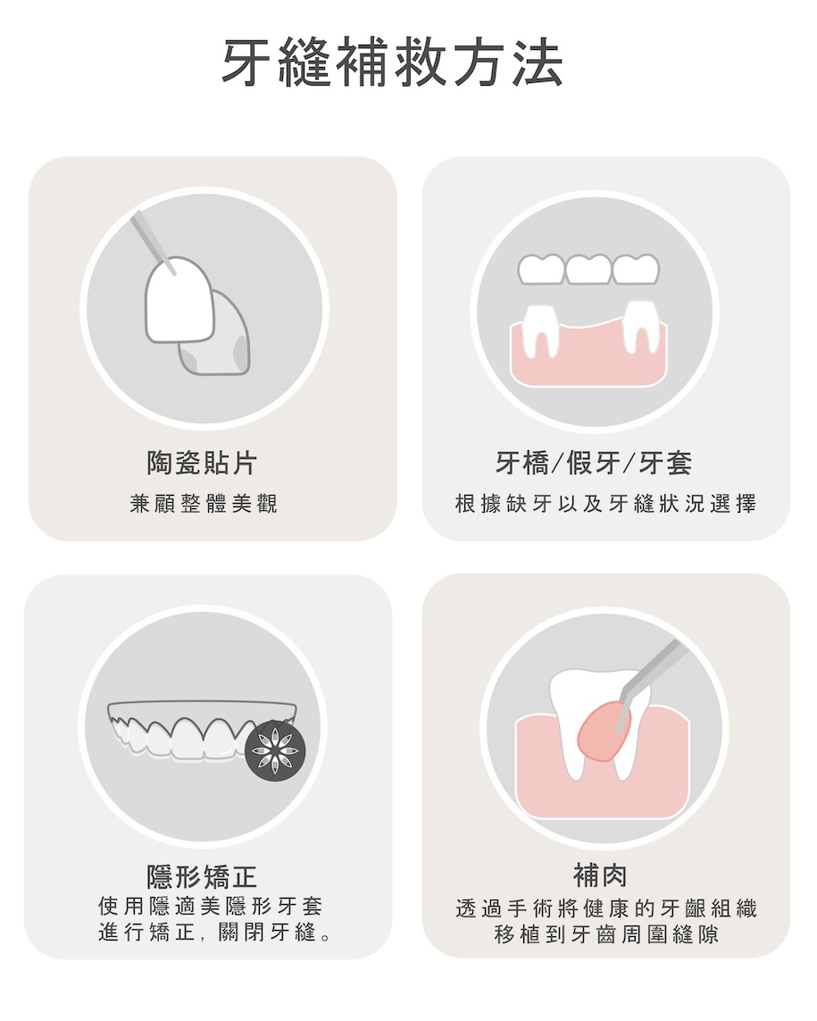四種門牙縫補救方式示意圖,依不同牙齒條件與需求,常見包括陶瓷貼片、假牙、矯正與牙肉補肉等方式