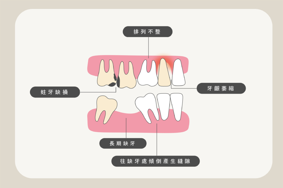 牙齒蛀牙與長期缺牙不補易導致牙齒傾斜、牙齦萎縮與牙縫變大示意圖