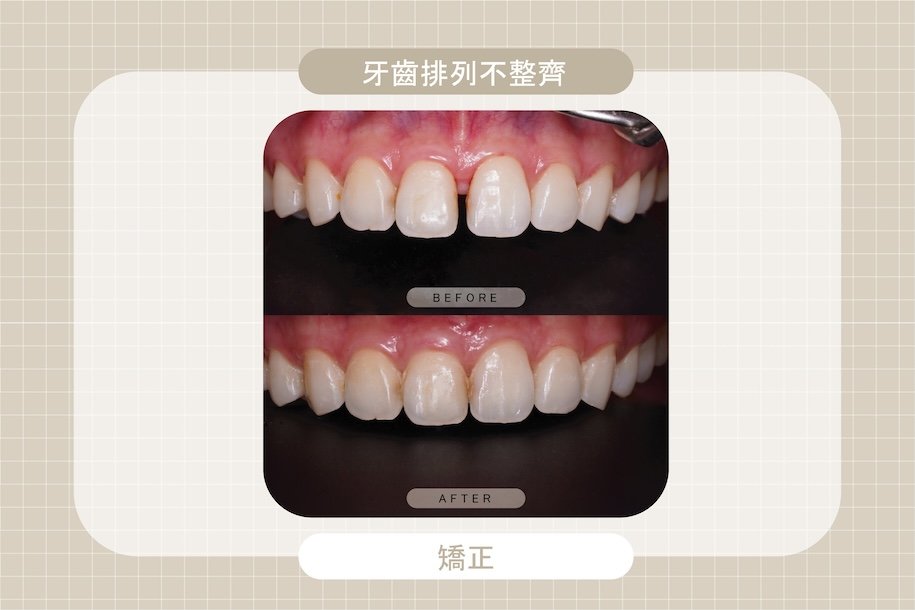 牙齒排列不整齊導致門牙縫隙明顯，經由齒顎矯正治療改善齒列與牙縫問題，提升整體美觀