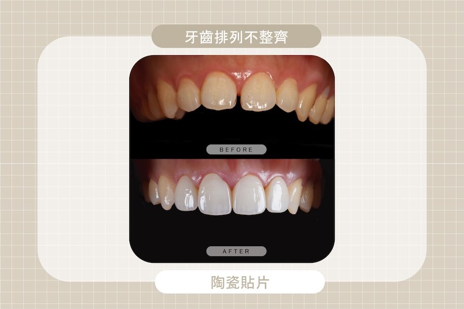 牙齒排列不整齊導致門牙縫隙明顯，透過陶瓷貼片調整齒列形狀與顏色，改善牙縫問題與美觀度