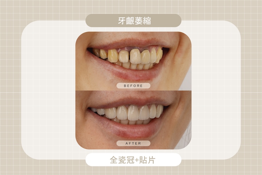 牙齦萎縮造成牙縫明顯與牙齒比例不協調，經由全瓷冠搭配陶瓷貼片關牙縫，重建牙齒外觀