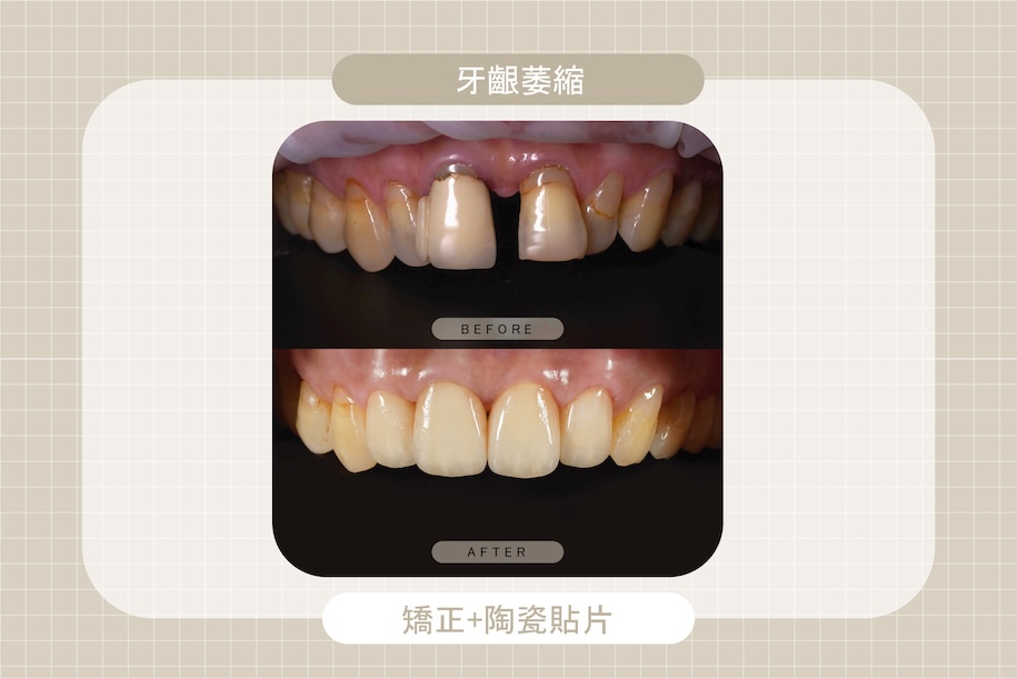 牙齦萎縮導致牙縫變大且牙齒外型不美，透過矯正搭配陶瓷貼片改善齒列與牙齦比例，重建自然微笑