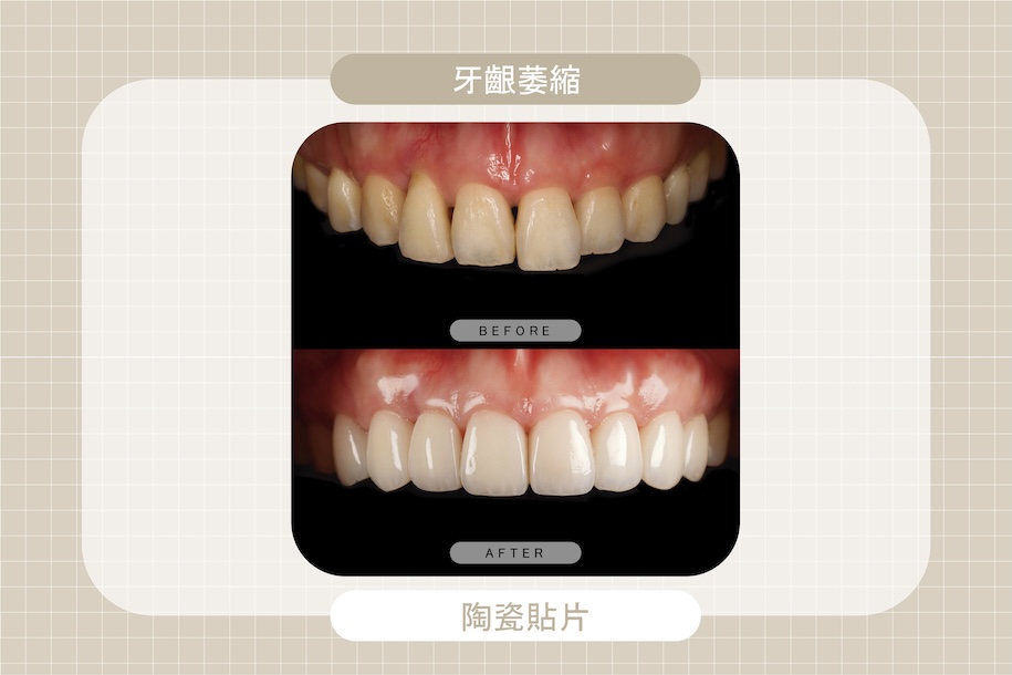 牙齦萎縮導致齒縫明顯與牙齒外觀不協調，經由陶瓷貼片改善牙齒型態與色澤，使笑容更自然