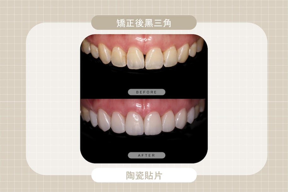矯正後黑三角導致門牙牙縫明顯，透過陶瓷貼片治療關牙縫，改善牙齒型態與色澤