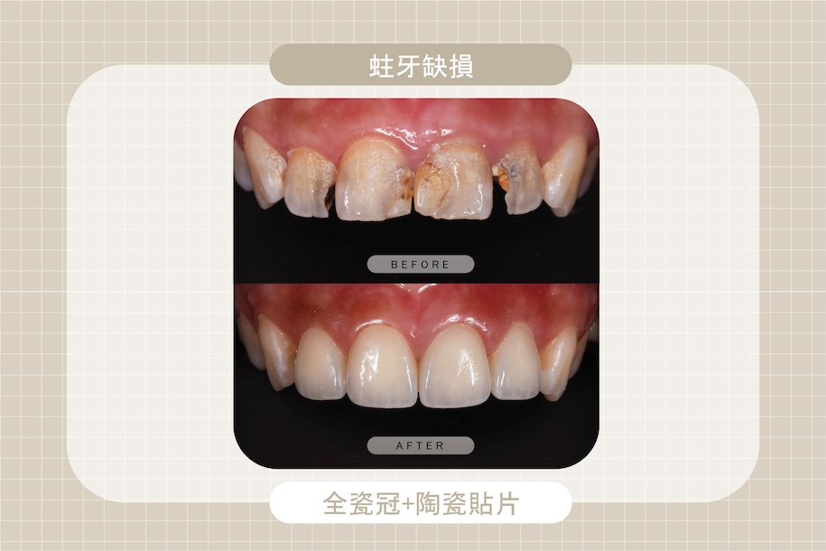 門牙因嚴重蛀牙導致缺損與牙縫明顯，透過全瓷冠與陶瓷貼片修復，恢復牙齒完整外型與自然色澤