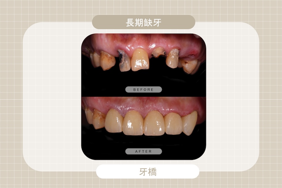 長期缺牙造成門牙牙縫大與咬合問題，透過牙橋重建，恢復牙齒排列與整體美觀