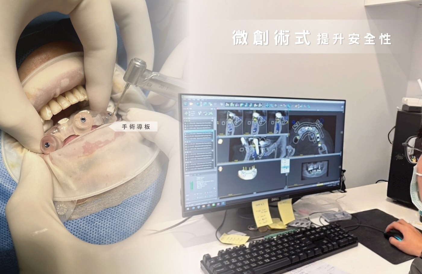 All-on-4 微創植牙手術中使用數位手術導板進行植體定位