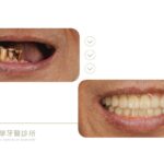 抗凝血劑-植牙-all-on-4-全口重建-台中-推薦-御耀美學牙醫