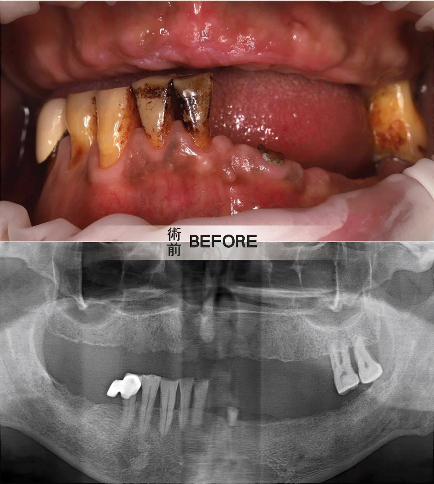 抗凝血劑患者術前口內照與全口X光影像評估