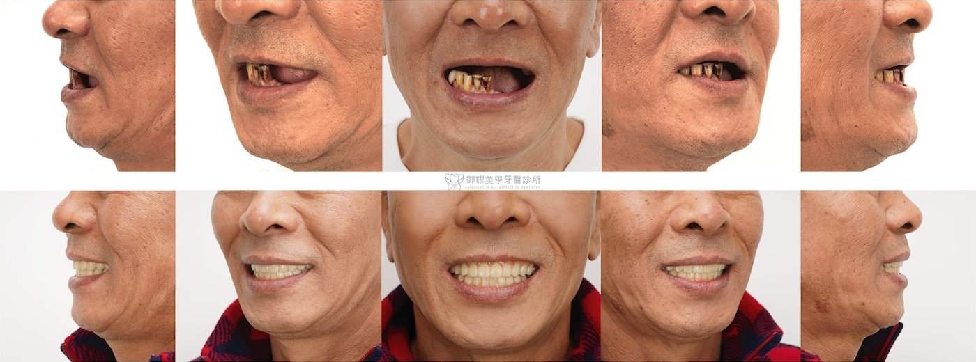 All-on-4 全口重建術前術後臉型支撐與微笑曲線改善比較
