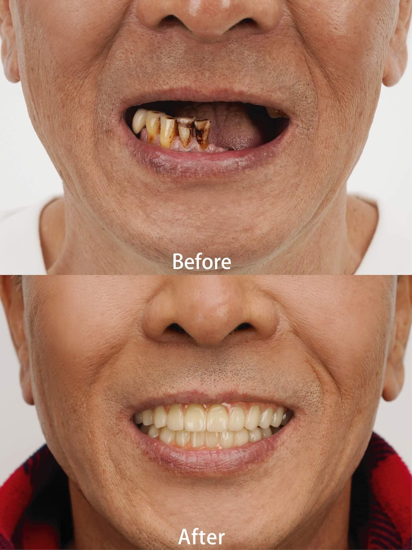 抗凝血劑患者 All-on-6 全口重建前後對比照