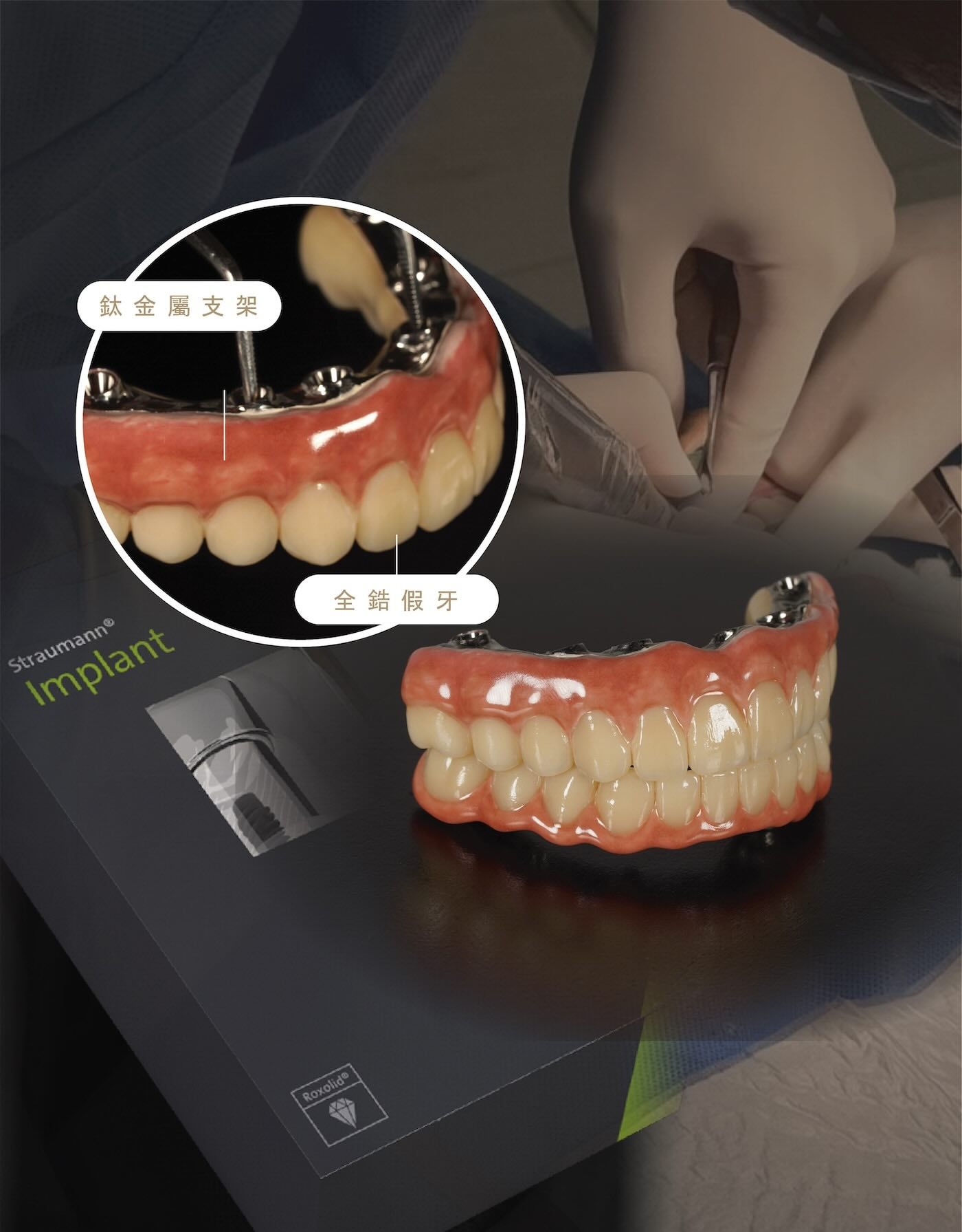 All-on-4 全口重建結構示意圖,展示鈦金屬支架結合全鋯假牙的固定式重建設計