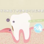 牙周再生凝膠-台中牙周病治療-推薦-御耀美學牙醫