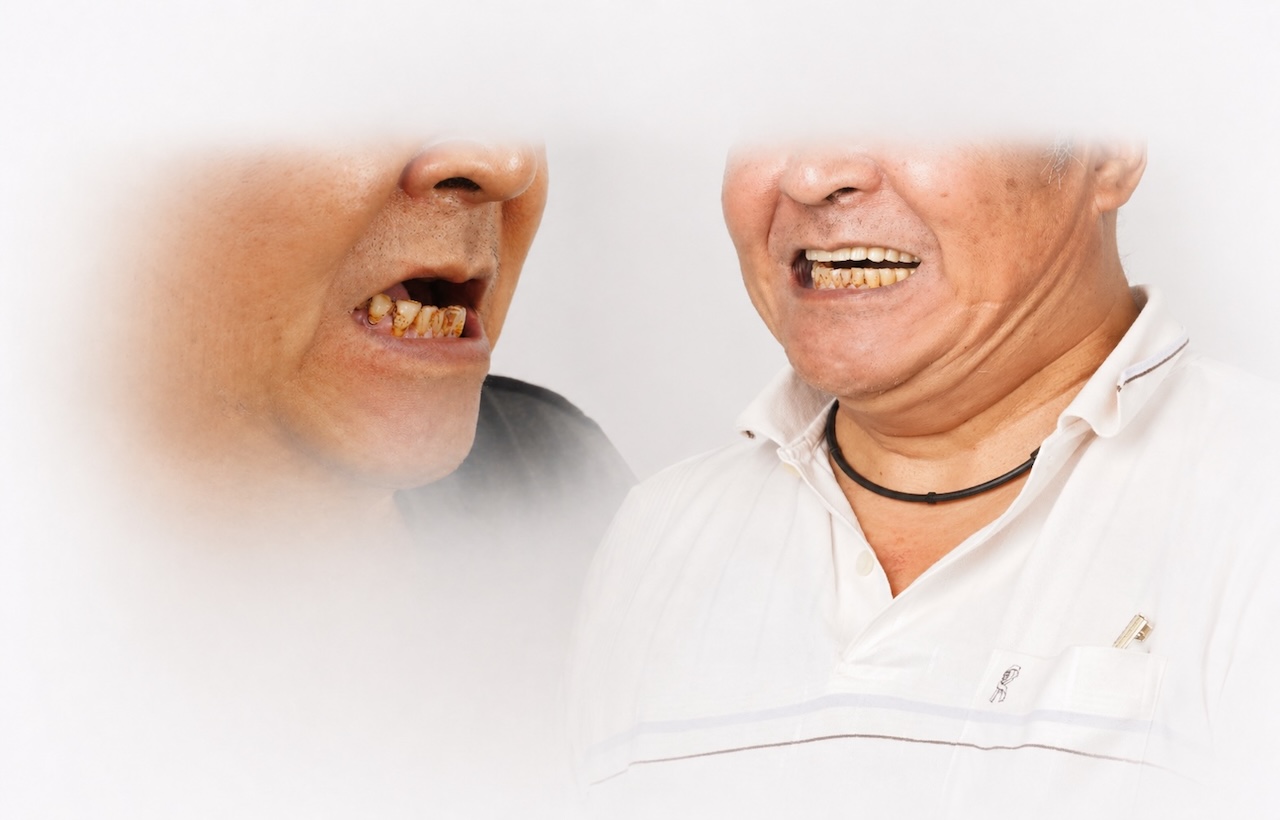 全口無牙-bps吸附式假牙-all-on-4-植牙-全口重建-推薦-台中-御耀美學牙醫