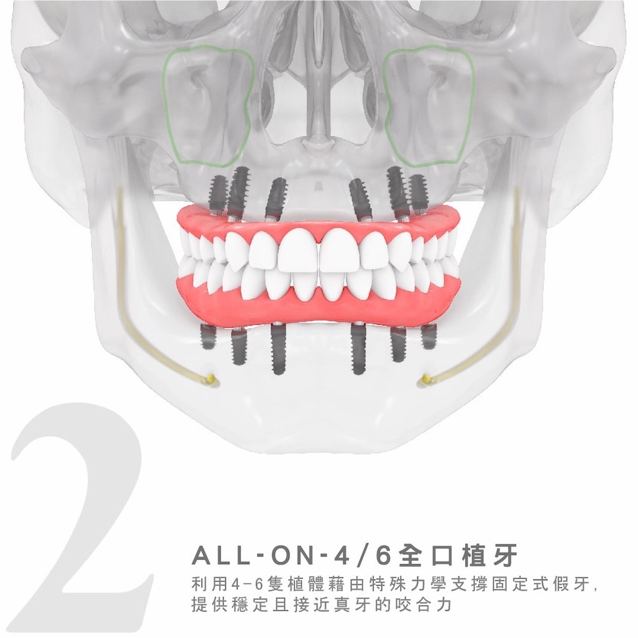 All-on-4/6全口植牙以 4-6 支植體支撐固定式假牙示意圖