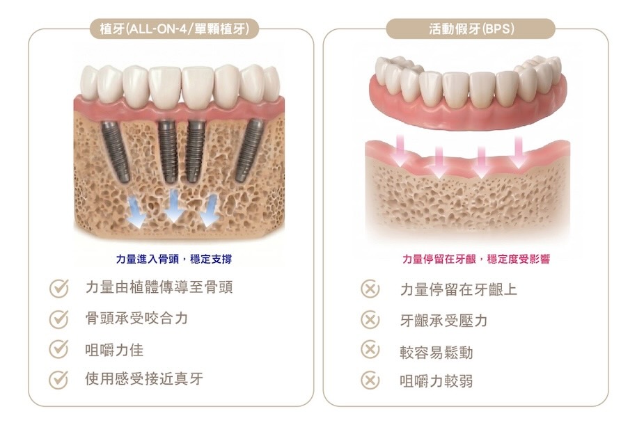 植牙與BPS活動假牙受力差異比較圖