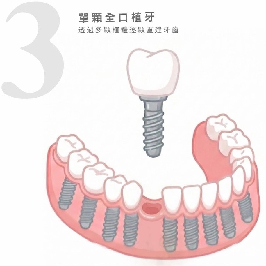 單顆全口植牙透過多支植體逐顆重建牙齒示意圖