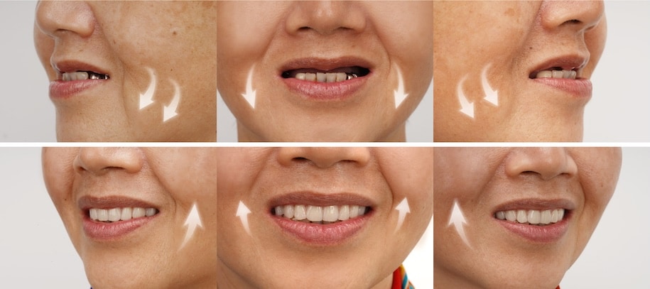 大範圍缺牙全口重建前後臉型支撐對比
