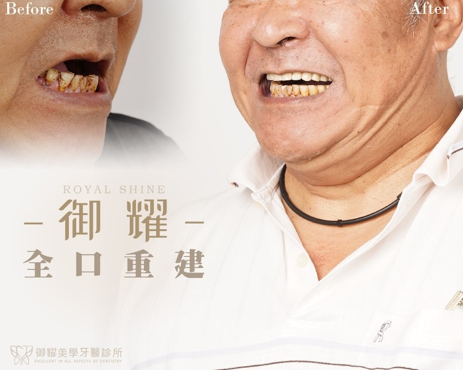 大範圍缺牙患者經御耀全口重建改善咀嚼與笑容外觀