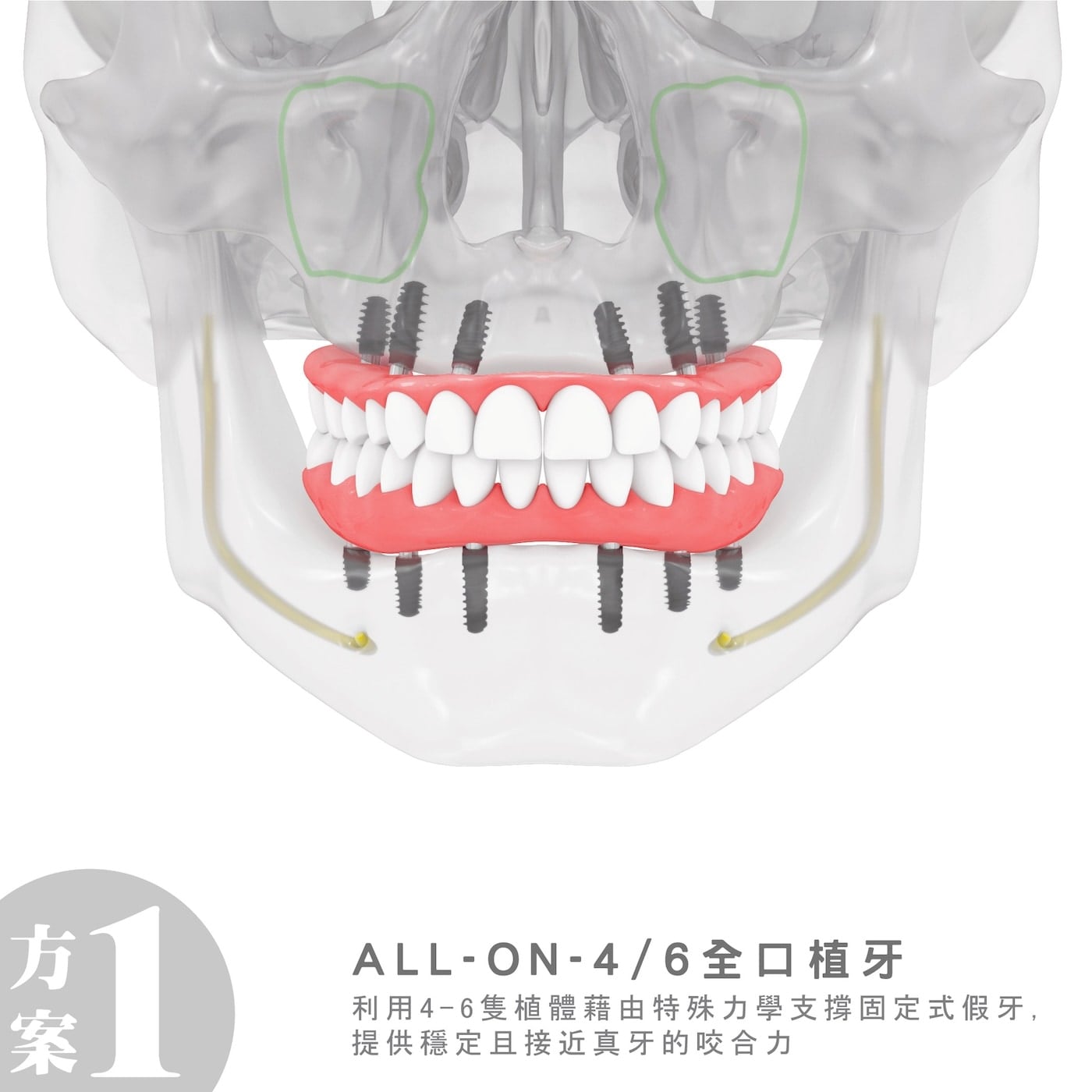 All-on-4全口植牙治療方式示意圖
