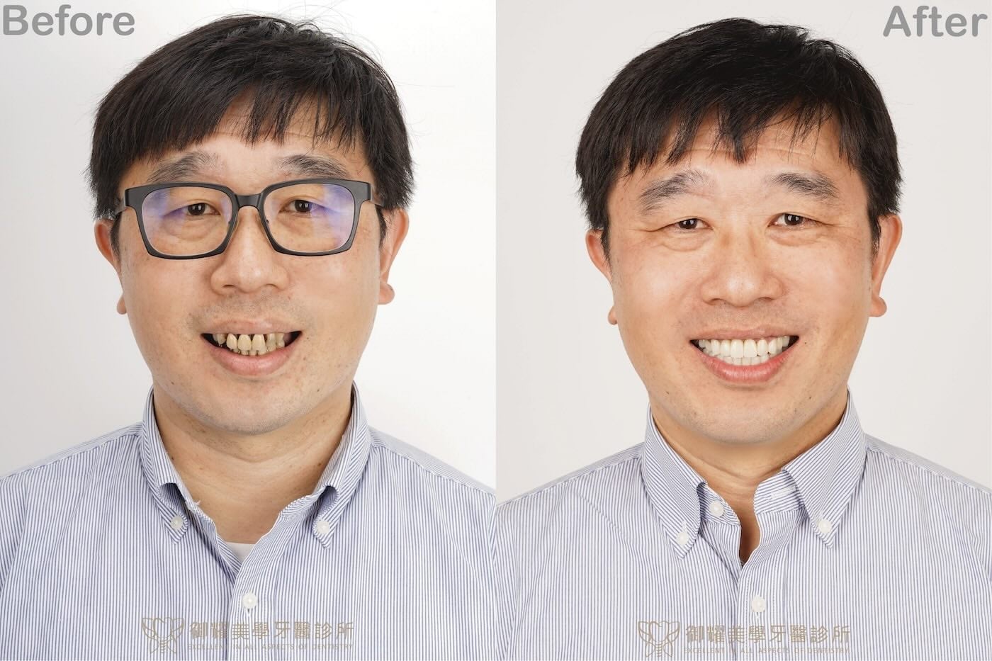 多顆缺牙患者全口重建治療前後笑容對比